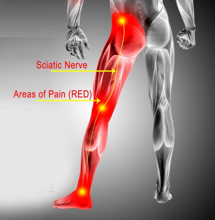 Sciatic Nerve, showing impingement and sites of pain